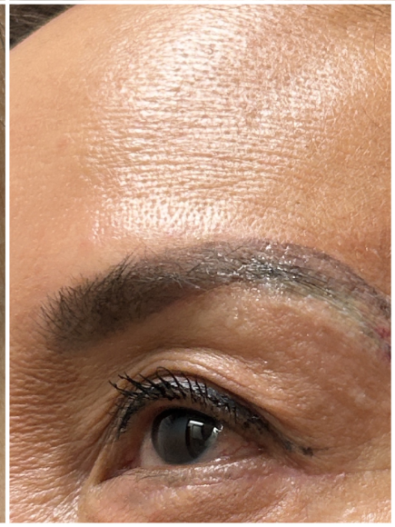 Pico Laser, Tattoo Removal after — Unwanted Cosmetic Tattoo, Eyebrow Tattoo Fading, Pigment Migration, front view
