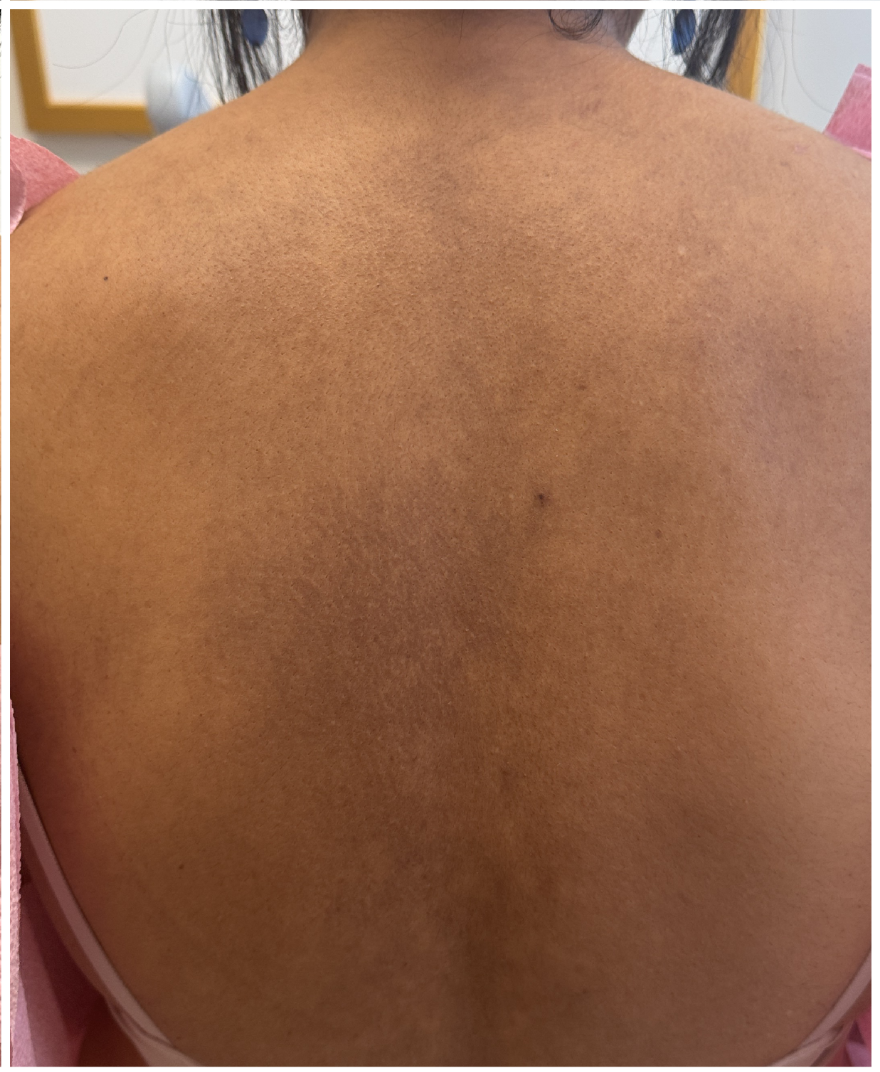Pico Laser after — Hyperpigmentation, Sun Damage, Post-Inflammatory Hyperpigmentation, front view