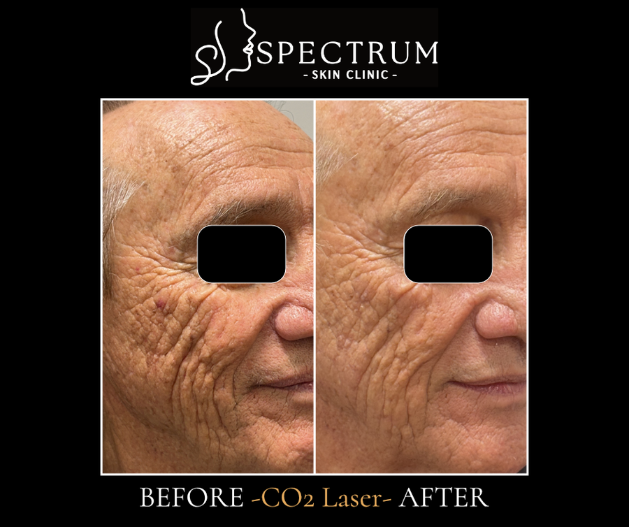 CO2 Laser Before & After | Crow’s Feet and Cheek Wrinkle Resurfacing