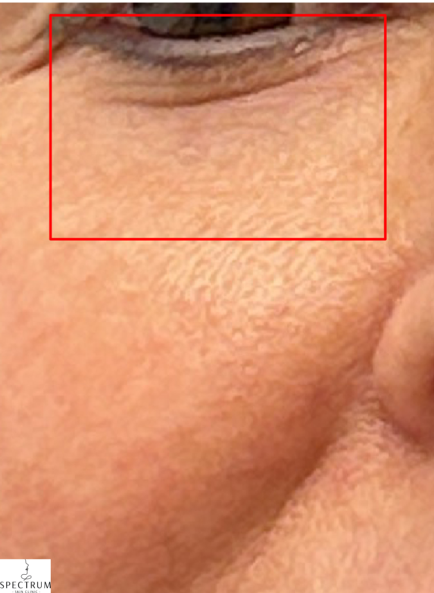 Filler Dissolve after — Under Eye Hollows, Tear Trough, Under Eye Bags and Puffiness, front view