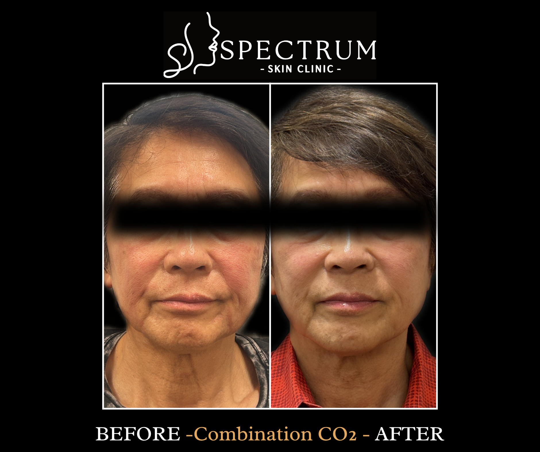 CO2 Laser Resurfacing Before & After | Skin Renewal in a Male Patient
