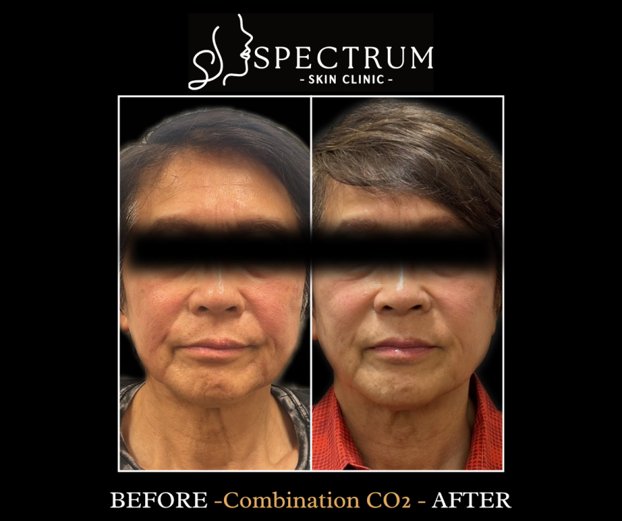CO2 Laser Resurfacing Before & After | Skin Renewal in a Male Patient