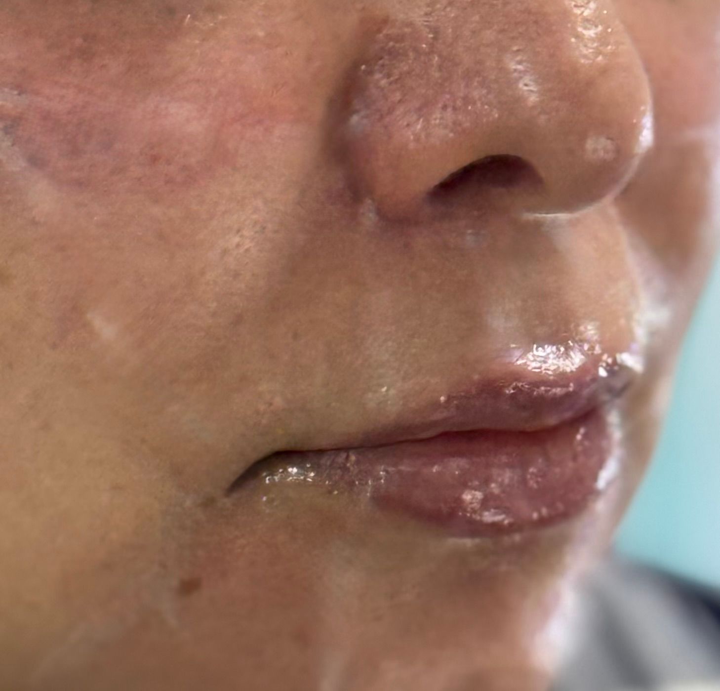 Lip Filler before — Perioral Volume, Lip Shape, front view