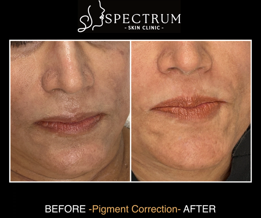 Chemical Peel Before and After | Pigment Correction and Melasma