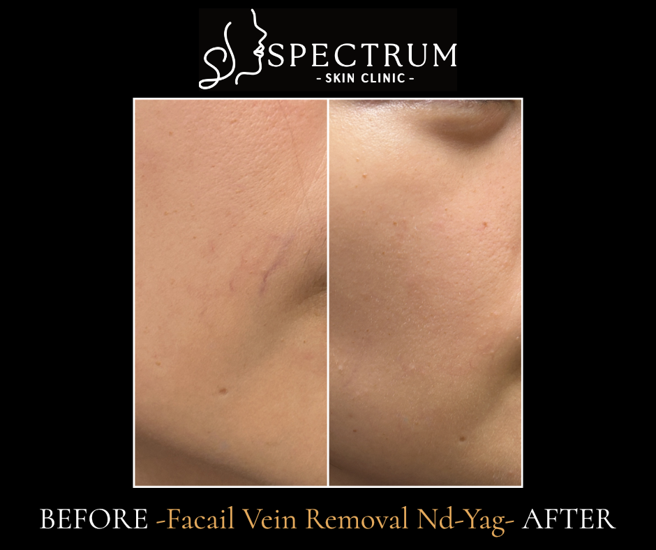 Laser Vein Removal Before & After | Facial Vein Clearance