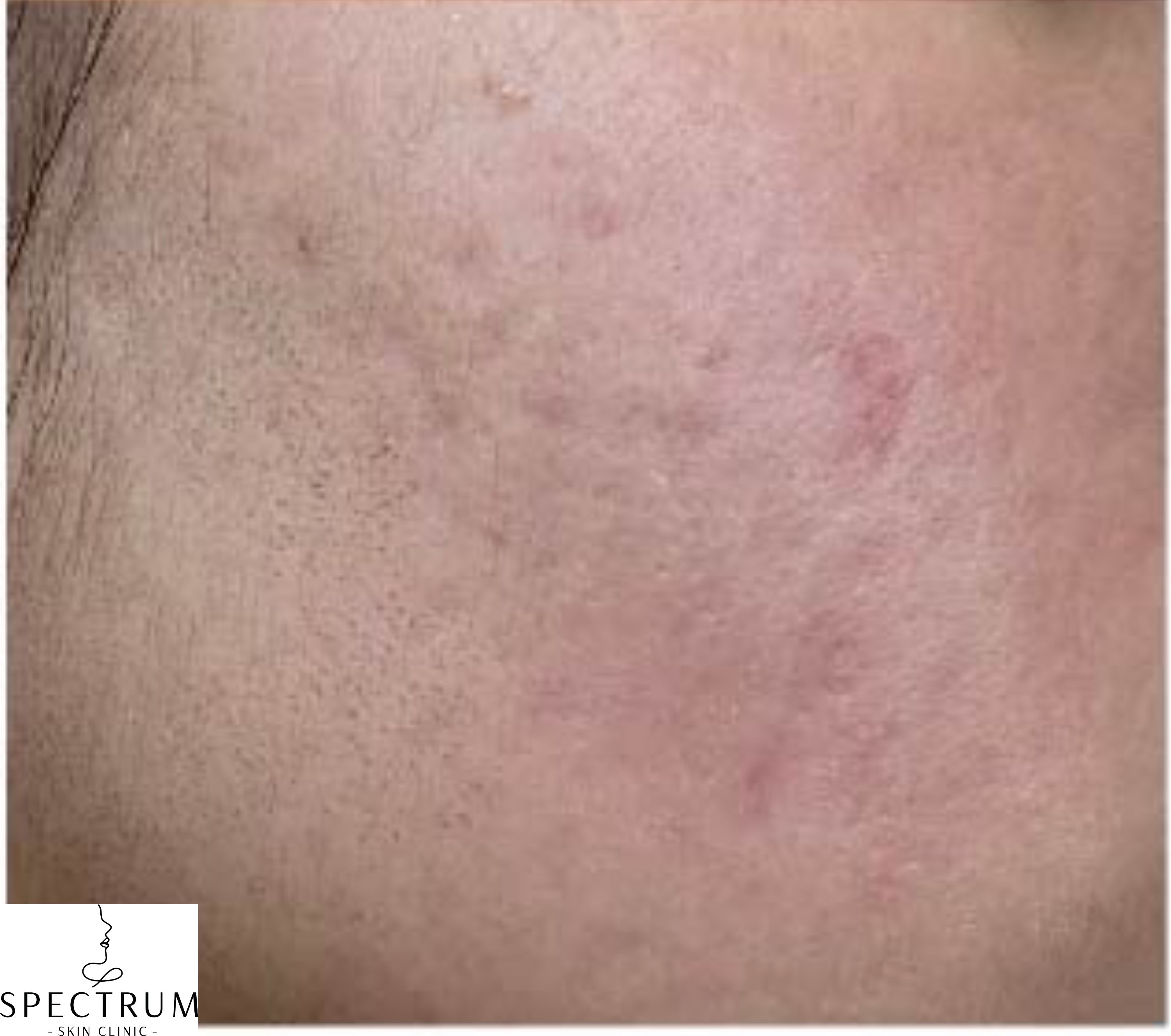 RF Microneedling, TCA CROSS Peel after — Acne Scars, Active Acne, Uneven Texture, front view