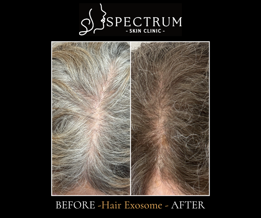 Exosome Therapy Before and After, Female Crown and Central Part Density at Spectrum Skin Clinic, Irvine
