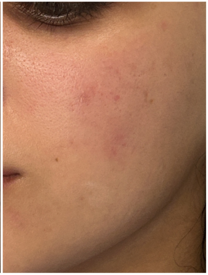 Acne Facial after — Persistent Acne, Comedones, Active Acne, Inflammatory Acne, front view