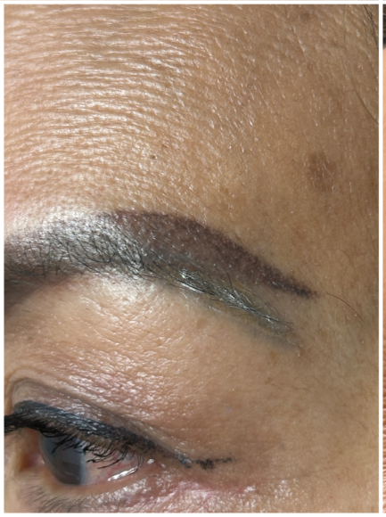 Pico Laser, Tattoo Removal before — Unwanted Cosmetic Tattoo, Eyebrow Tattoo Fading, Pigment Migration, front view