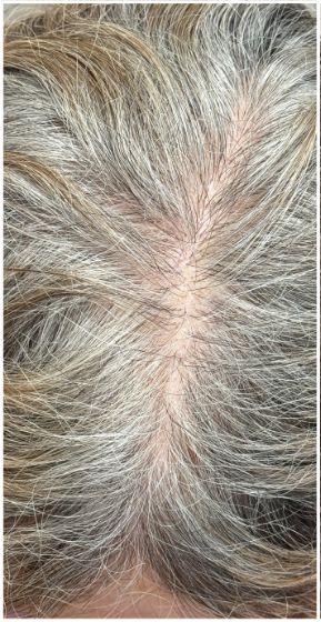 Exosome Hair Therapy before — Female Pattern Hair Loss, Crown Thinning, Central Part Widening, front view