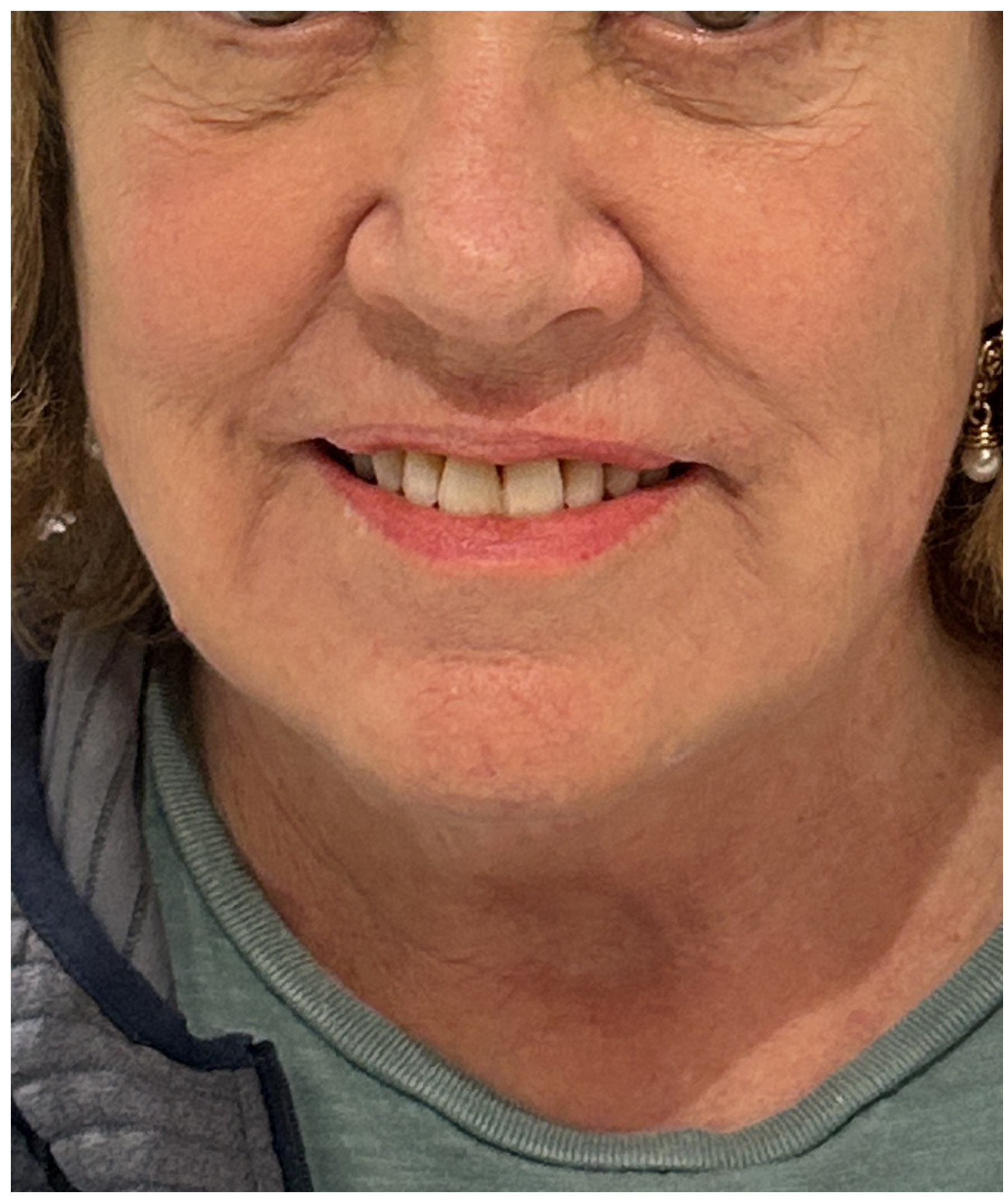 eMatrix Sublative RF Resurfacing before — Fine Lines and Wrinkles, Sagging and Laxity, Uneven Texture, front view