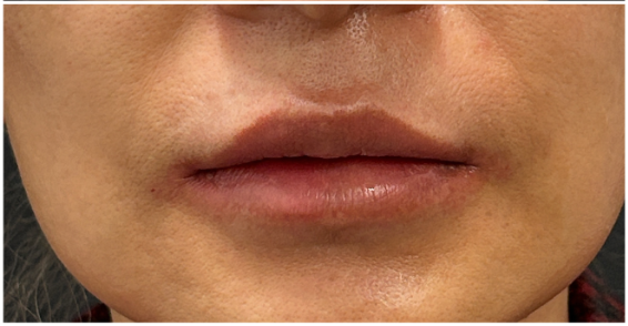 Lip Filler after — Lip Asymmetry, front view