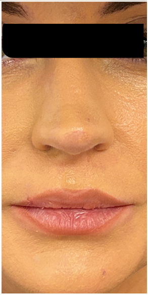 Lip Filler before — Thin Lips, front view