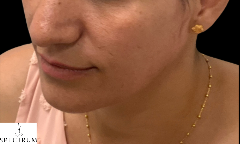 Nasolabial Fold Filler after — Nasolabial Folds, Midface Volume Loss, front view
