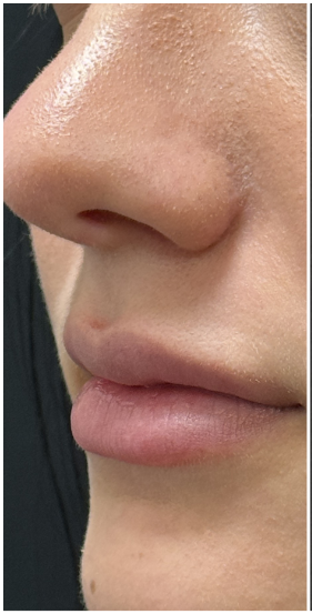 Lip Filler before — Thin Lips, front view