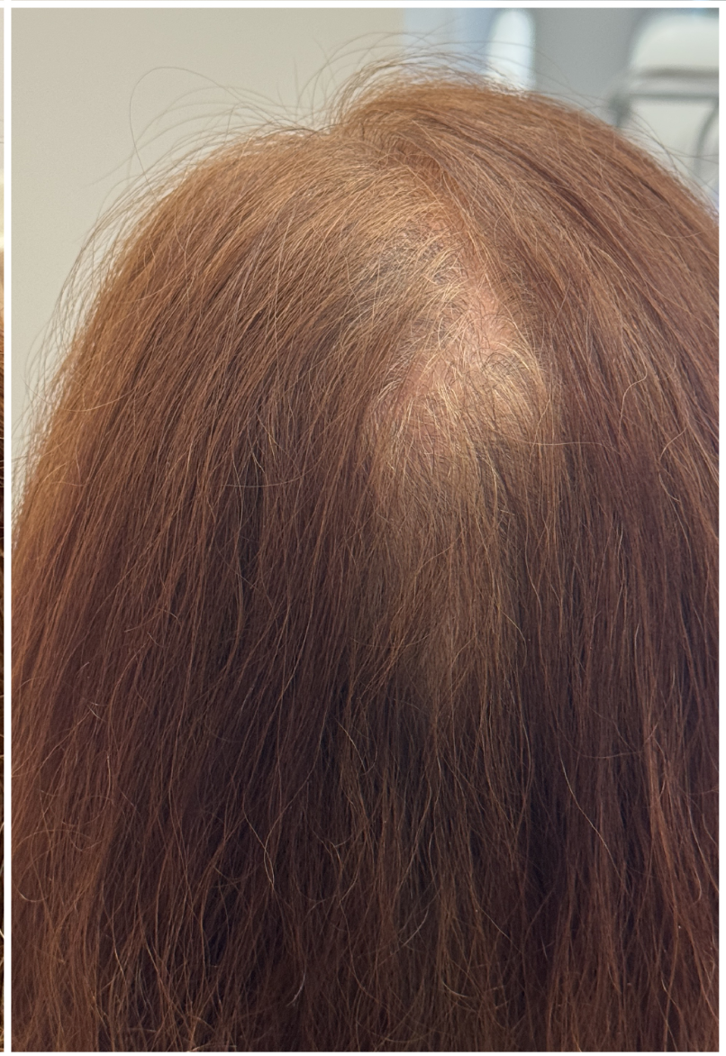 Exosome Hair Therapy after — Female Pattern Hair Loss, Crown Thinning, Hair Density Loss, front view