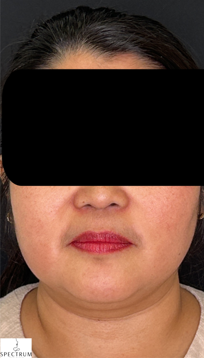 HIFU before — Sagging and Laxity, Double Chin, Skin Tightening, front view