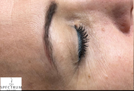 Botox before — Crow's Feet, front view