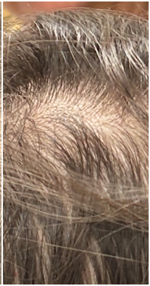 Exosome Therapy after — Part Line Thinning, Crown Thinning, front view