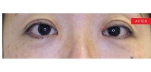 Laser Under-Eye Tightening after — , front view