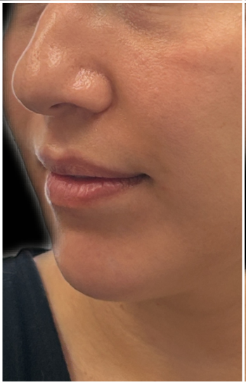 Lip Filler before — Thin Lips, front view