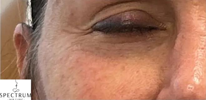 Filler Dissolve and Restoration after — Filler Migration, Distorted Midface, Over-Filled Cheeks, front view