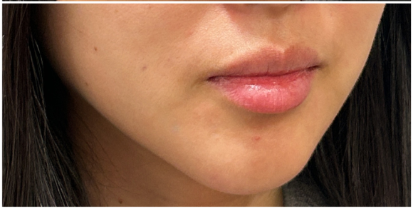 Filler Dissolve after — Filler Migration, Jawline Distortion, Lower Face Heaviness, front view