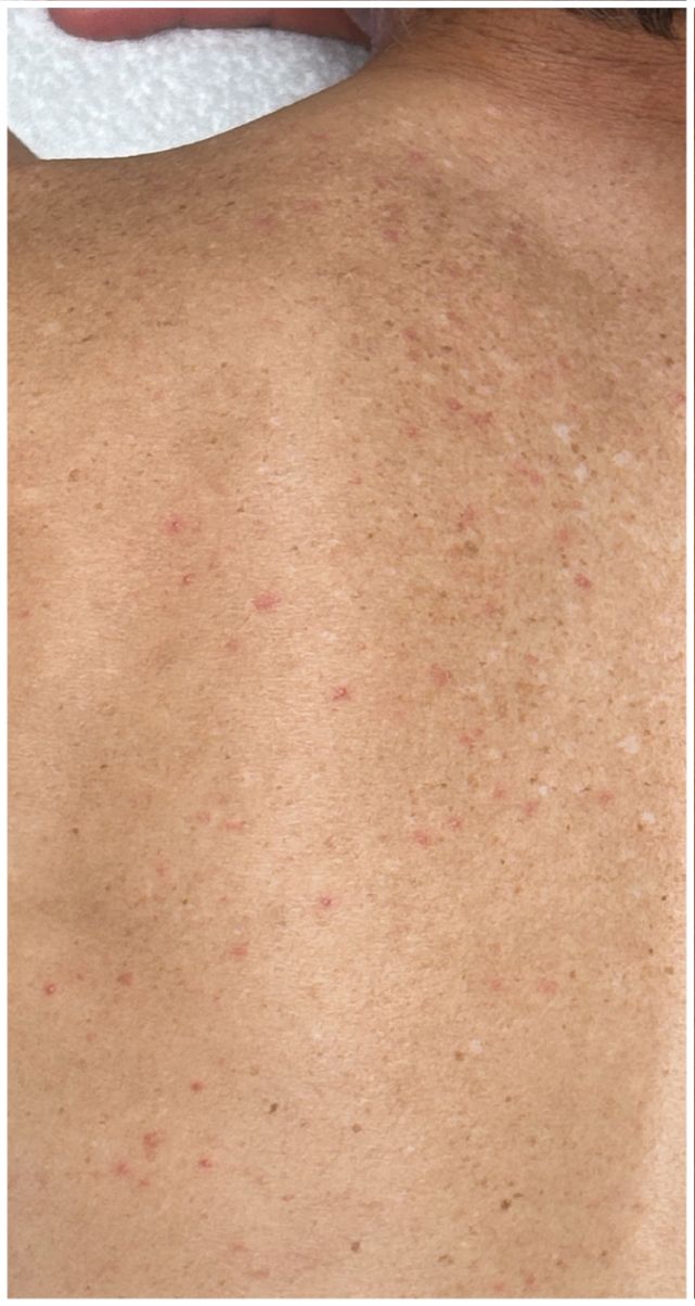 Acne Facial before — Back Acne, Body Acne, Active Acne, Comedones, front view
