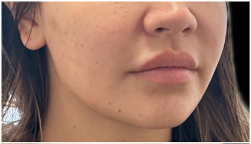 Masseter Botox before — Wide Jawline, front view