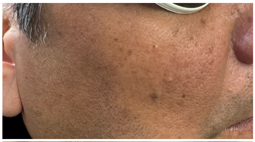 Pico Laser before — Hyperpigmentation, Sun Damage, Brown Spots, Solar Lentigines, front view