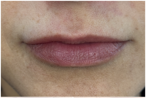 Lip Filler before — Thin Lips, front view