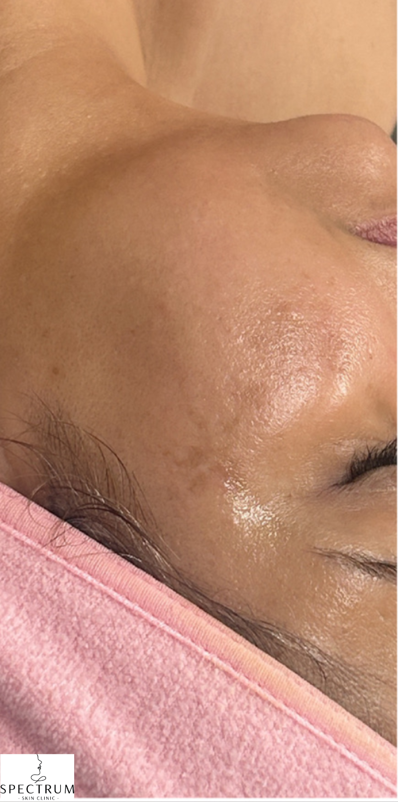 Chemical Peel for Acne Scarring after — Acne Scars, Post-Inflammatory Hyperpigmentation, Uneven Texture, front view