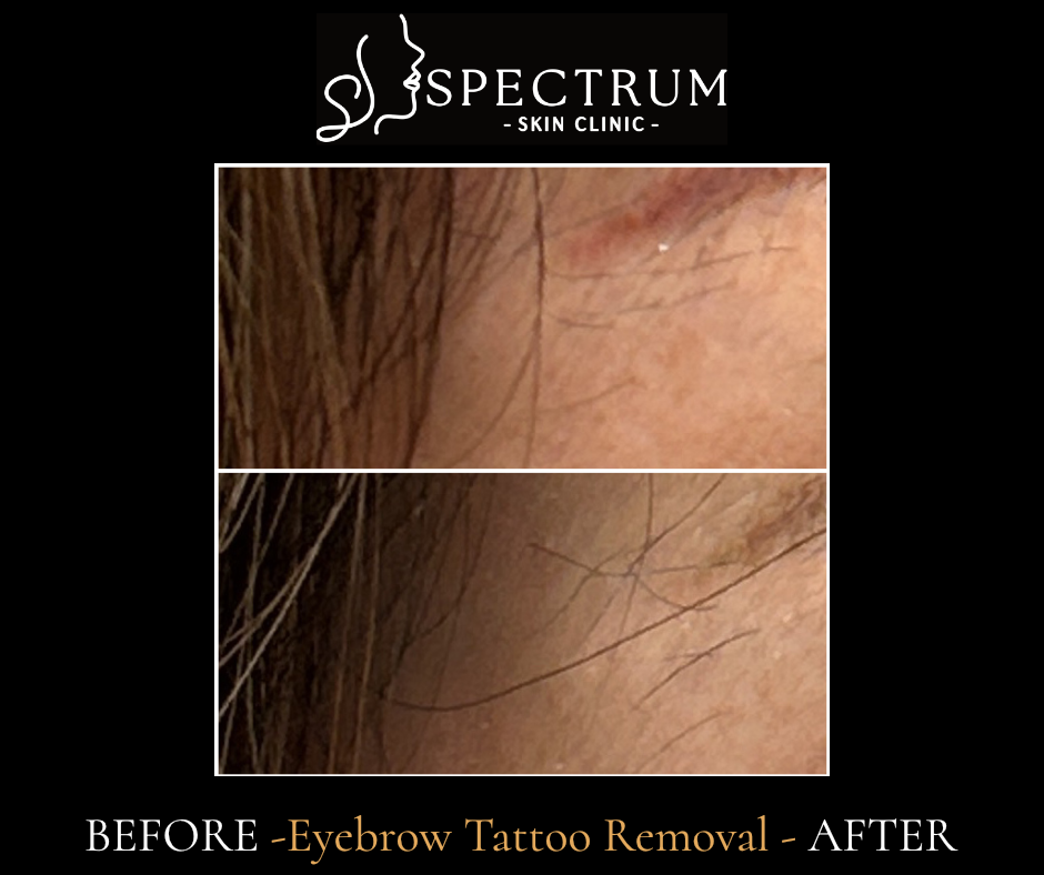 Eyebrow Tattoo Removal – Precise and Clean Results