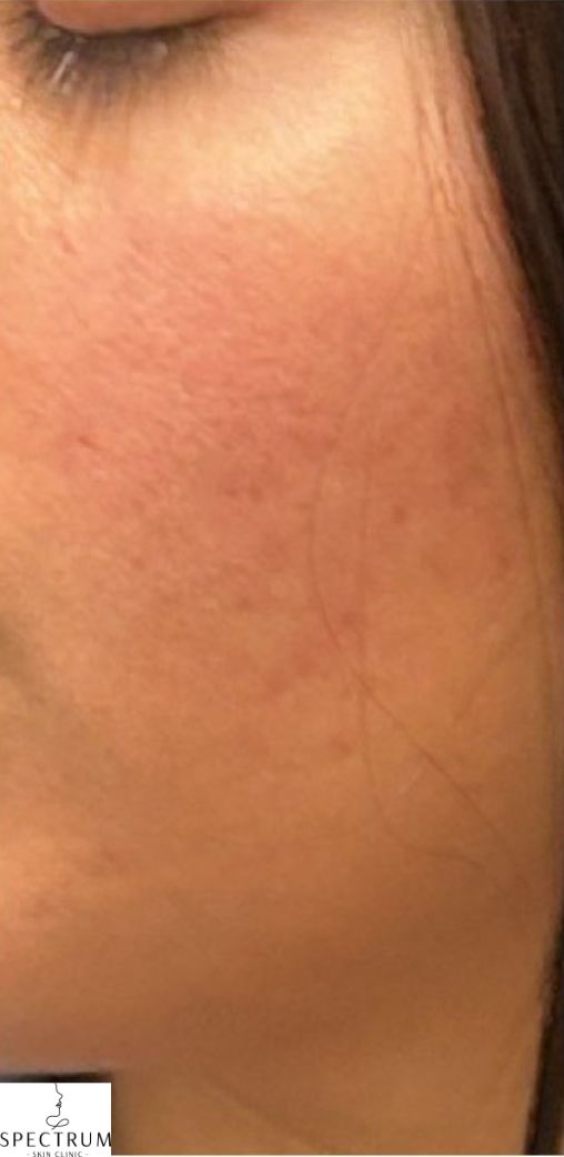 Salicylic Acid Peel after — Active Acne, Post-Inflammatory Hyperpigmentation, Uneven Texture, Inflamed Skin, front view