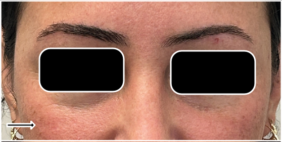 Filler Dissolve before — Under Eye Hollows, Under Eye Bags and Puffiness, Tear Trough, front view