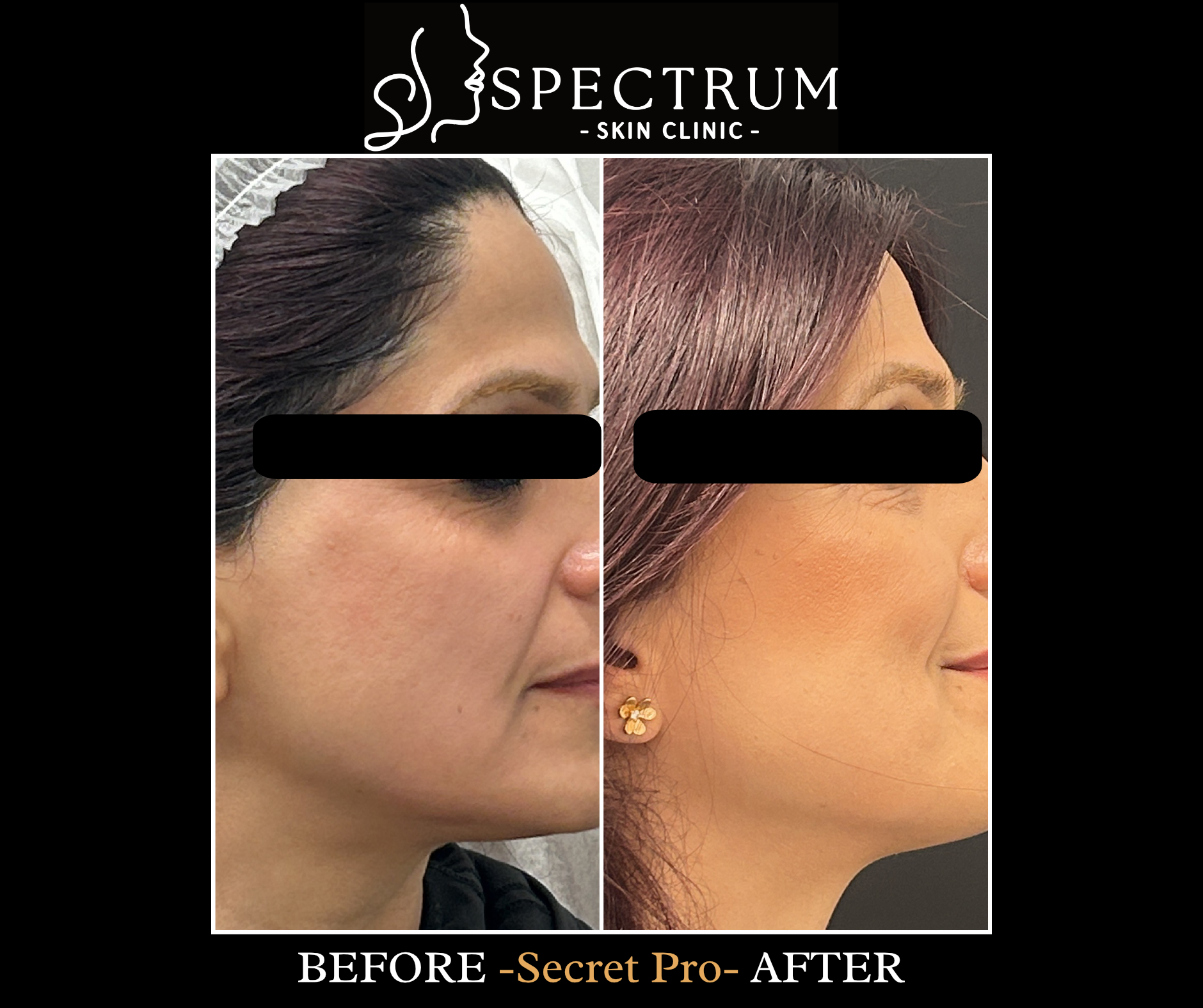 Secret PRO Before & After | Fine Line and Skin Renewal