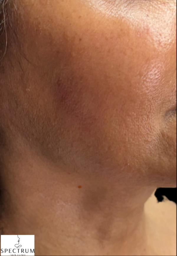 Chemical Peel after — Melasma, Hyperpigmentation, Uneven Skin Tone, Hormonal Pigmentation, front view