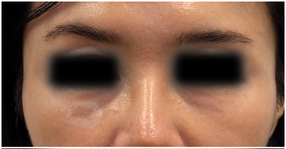 Under Eye Filler Dissolve before — Tyndall Effect, Under Eye Bags and Puffiness, Under Eye Hollows, Filler Migration, front view