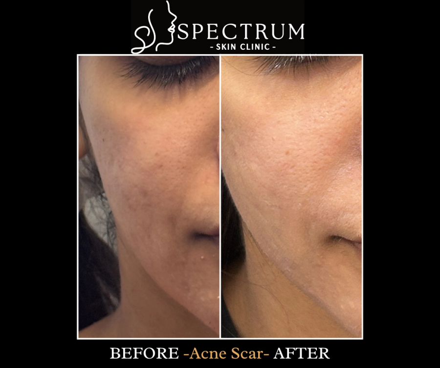 Acne Scar Treatment Before & After | Full-Face Resurfacing in Orange County