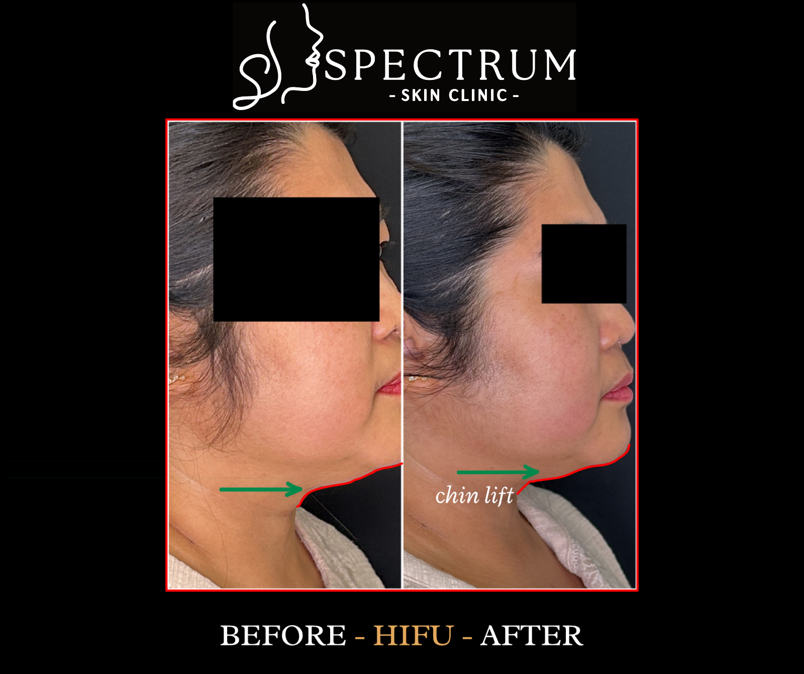HIFU Chin Lift Before & After | Submental Tightening and Chin Definition