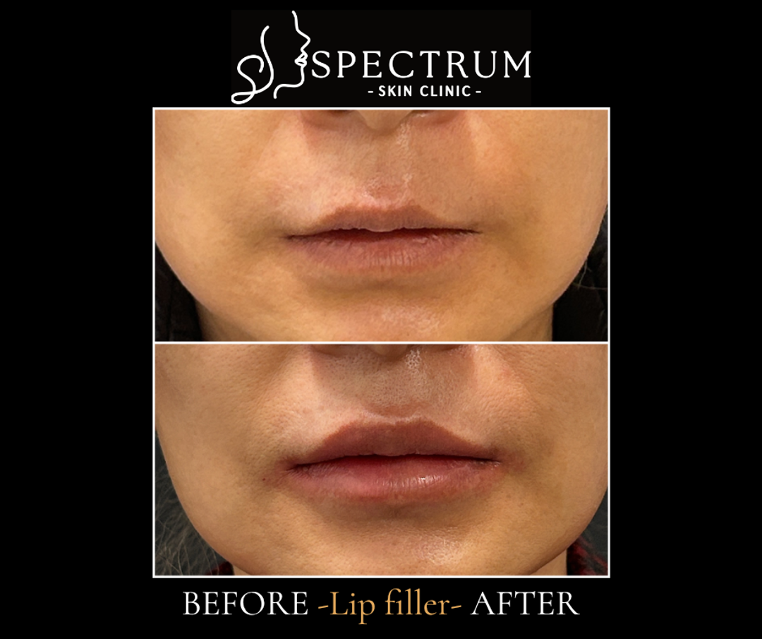 Lip Filler Before and After | Cupid's Bow Reshaping and Volume Enhancement