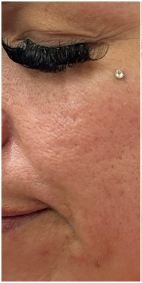 Microneedling with TCA CROSS Peel before — Acne Scars, Boxcar Scars, Pitted Scars, Uneven Texture, Post-Acne Hyperpigmentation, front view