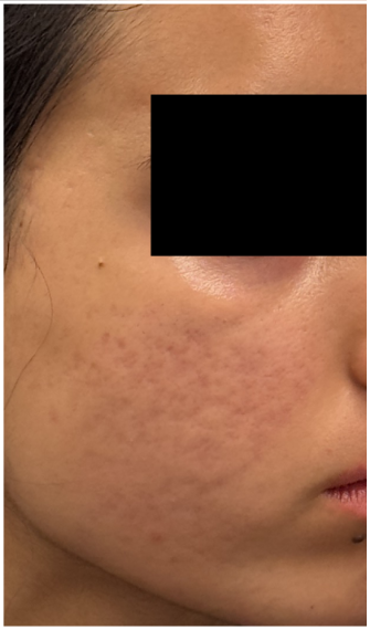 Microneedling with TCA CROSS Peel before — Acne Scars, Ice-Pick Scars, Uneven Texture, front view