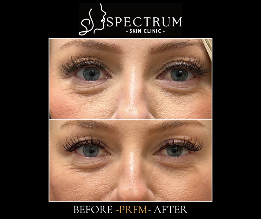 PRFM Under Eye Before & After | Skin Quality and Fine Line Refinement