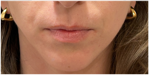 Filler Dissolve after — Nasolabial Folds, Filler Migration, Lower Face Heaviness, front view