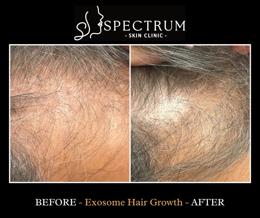 Exosome Therapy Before and After, Crown Density for Post-Menopausal Hair Thinning at Spectrum Skin Clinic, Irvine