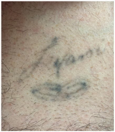 Pico Laser, Tattoo Removal after — Unwanted Tattoo, Tattoo Fading, Tattoo Removal, front view