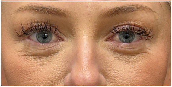 Filler Dissolve after — Under Eye Hollows, Under Eye Bags and Puffiness, Filler Migration, front view