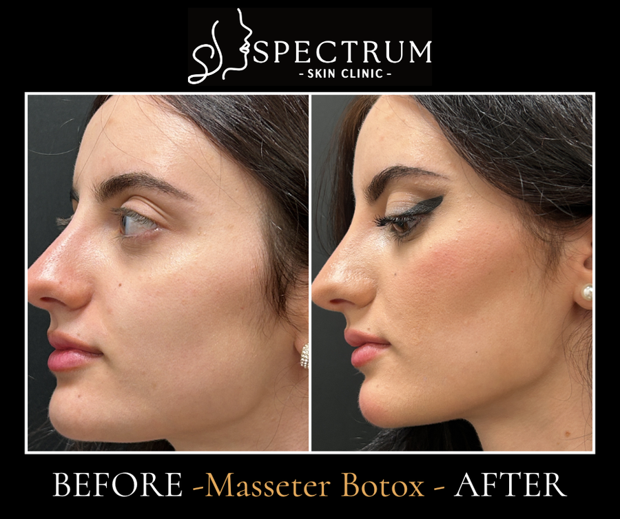 Jaw slimming from masseter Botox, treated personally by Dr. Sabeen Munib, MD. Individual results vary.