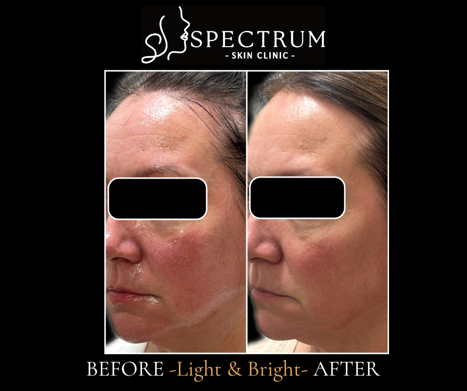 Light & Bright IPL Before & After | Even Tone and Reduced Redness